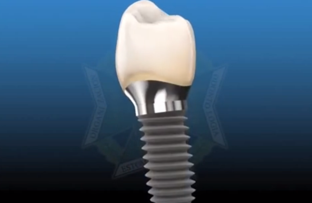 Implantes dentales